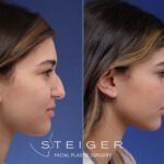 Alternatives to Rhinoplasty: Top Non-Surgical Nose Fixes