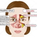 Alternatives to Sinus Surgery: Non-Surgical Treatments Explored