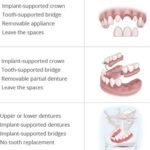 Alternatives to Pulling a Tooth: Top Preservation Methods