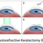 Alternatives to Laser Eye Surgery: Top LASIK Substitutes