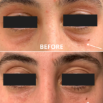 Alternatives to Eyelid Surgery: Top Non-Surgical Options