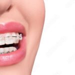 Alternatives to Jaw Surgery: TMJ & Overbite Non-Surgical Solutions