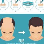 Alternatives to Finasteride: Safe & Affordable Options Explored